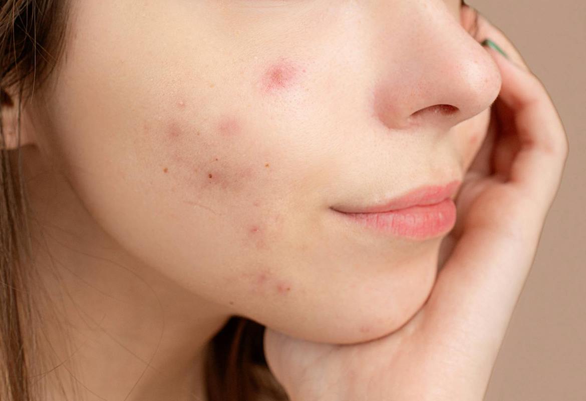 Late acne: puistjes en rimpels boven de 40